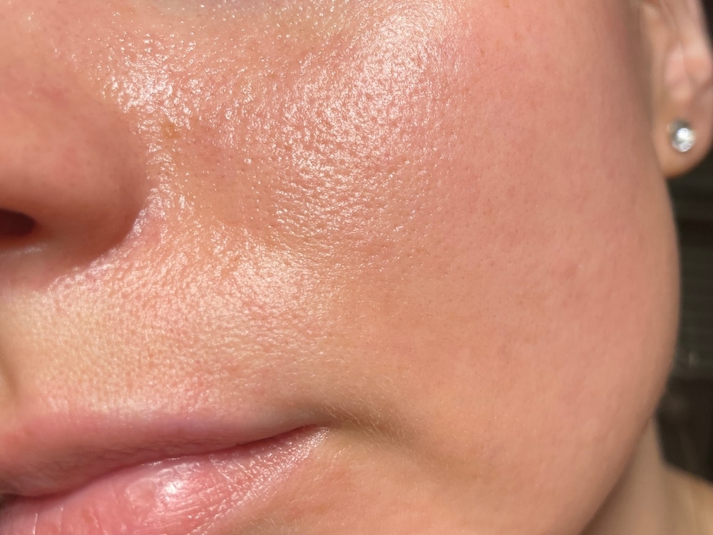 Huidverbetering bij SK Beauty Experts